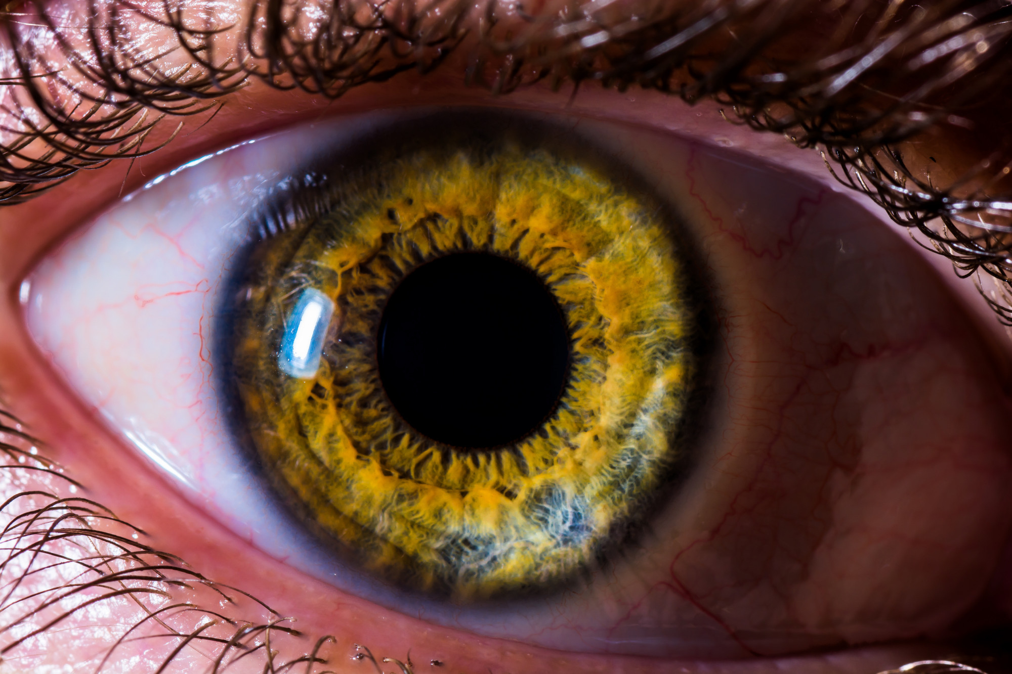 Желтый глаз 8. Желтые глаза. Глаукома глаза с экзофтальмом.